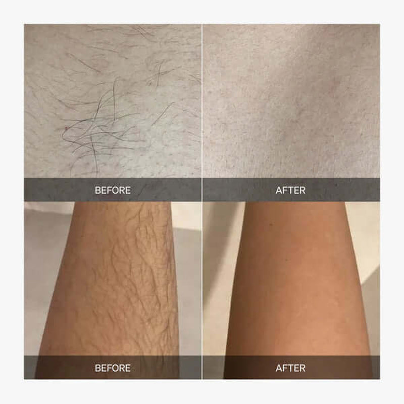 Advanced Laser Hair Removal Solutions