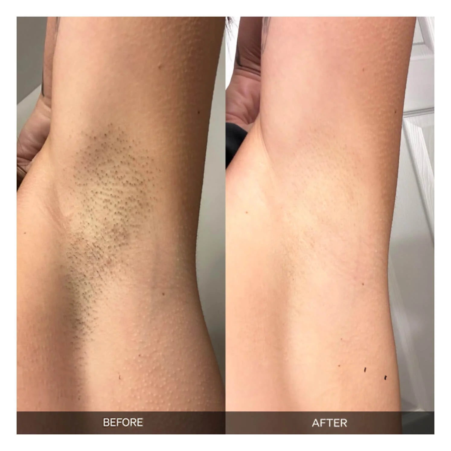 Advanced Laser Hair Removal Solutions